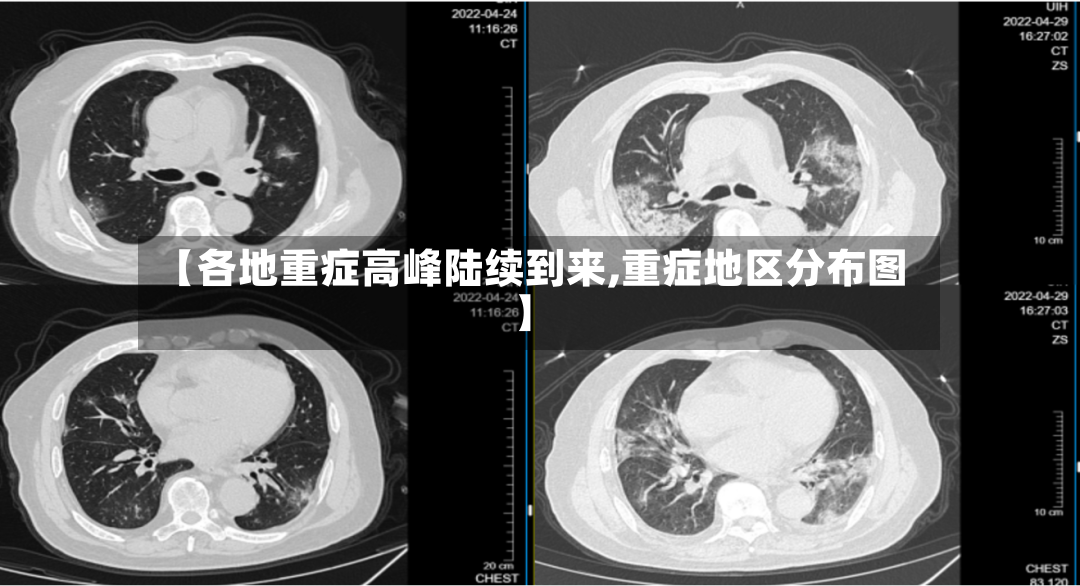 【各地重症高峰陆续到来,重症地区分布图】