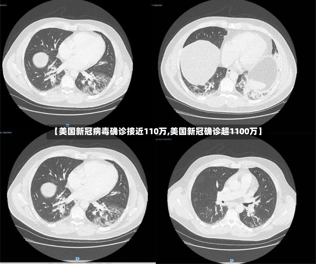 【美国新冠病毒确诊接近110万,美国新冠确诊超1100万】-第2张图片