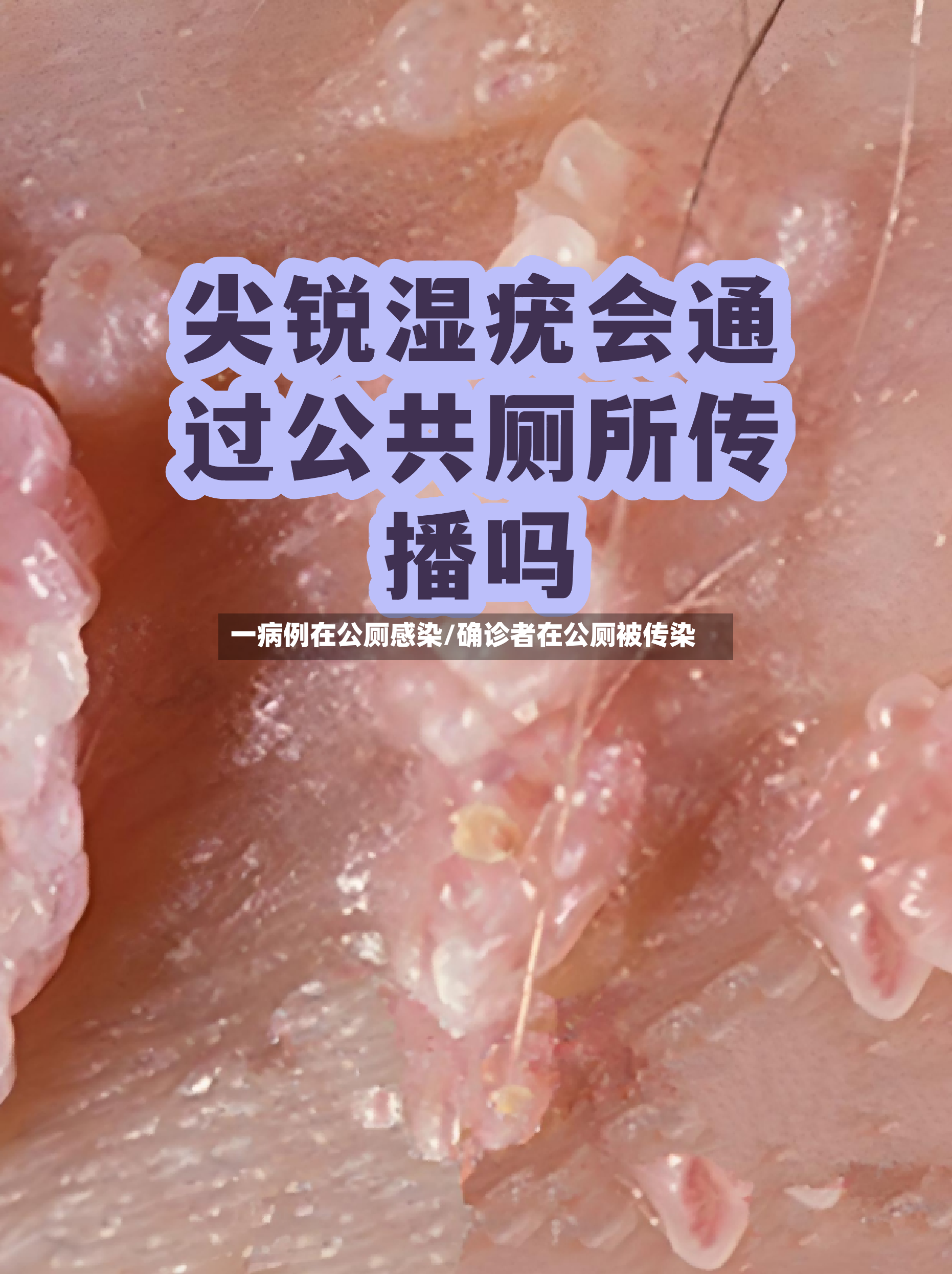 一病例在公厕感染/确诊者在公厕被传染-第2张图片