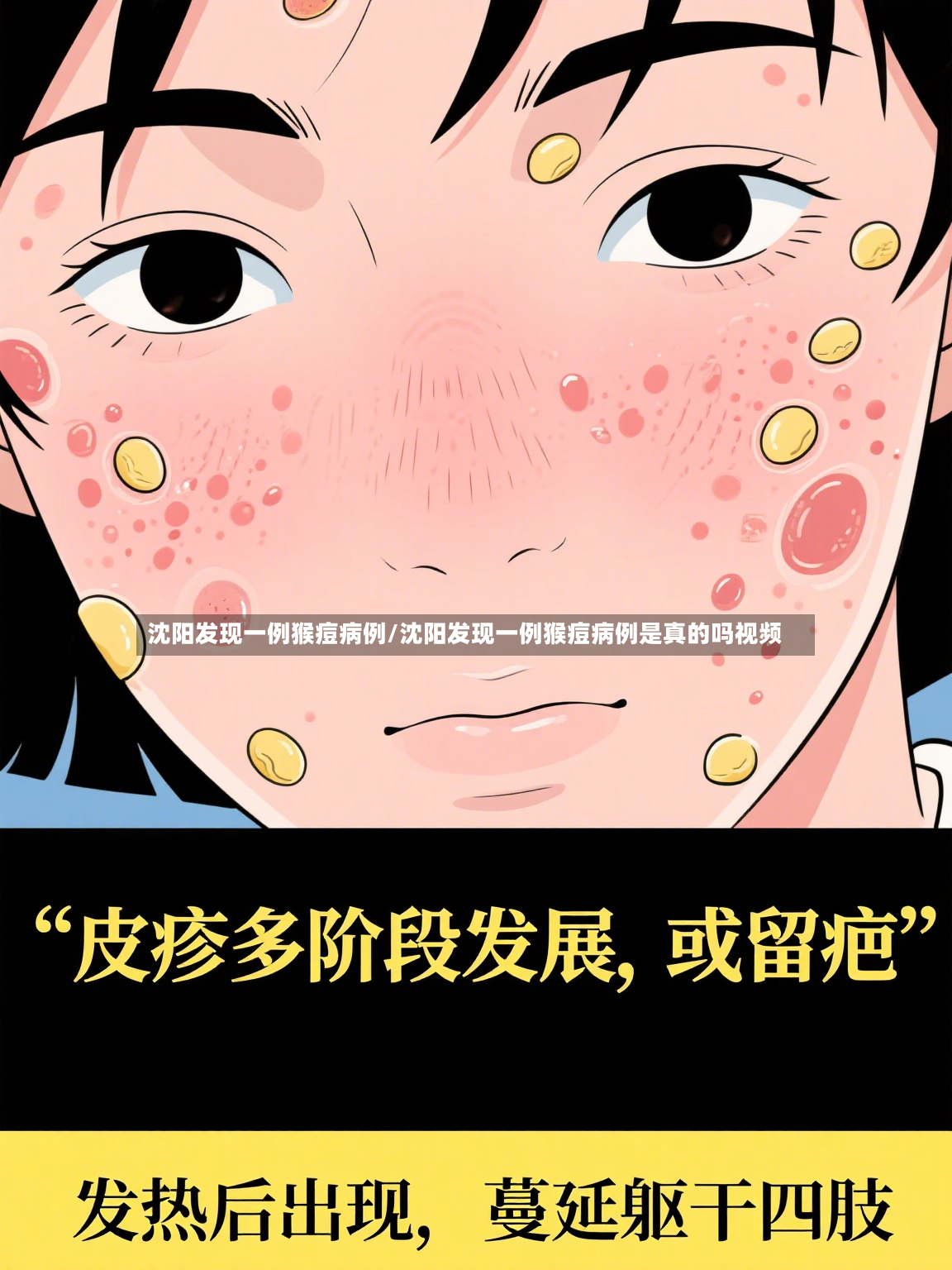 沈阳发现一例猴痘病例/沈阳发现一例猴痘病例是真的吗视频-第3张图片