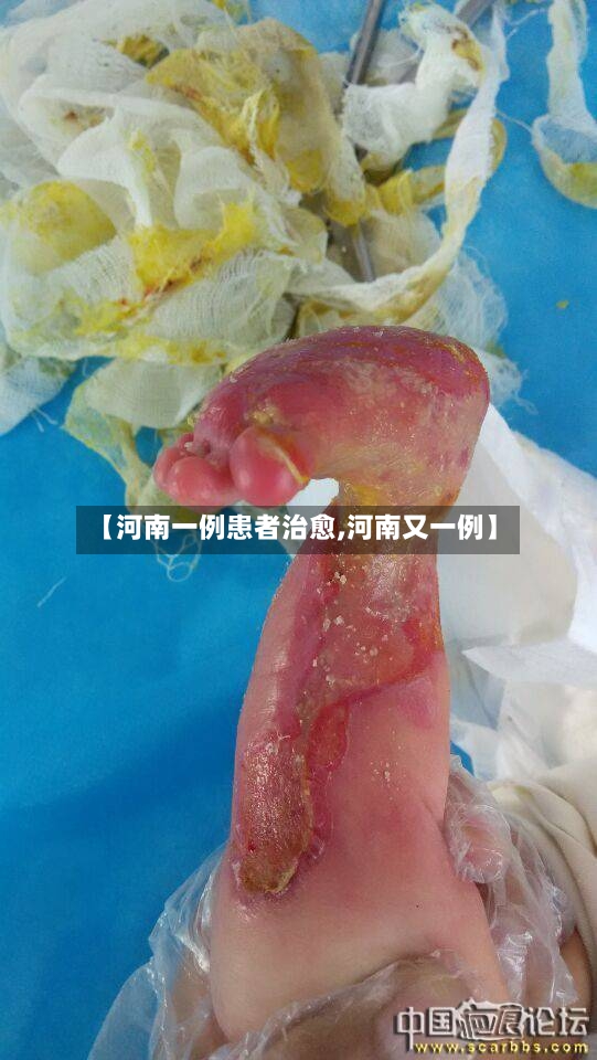 【河南一例患者治愈,河南又一例】