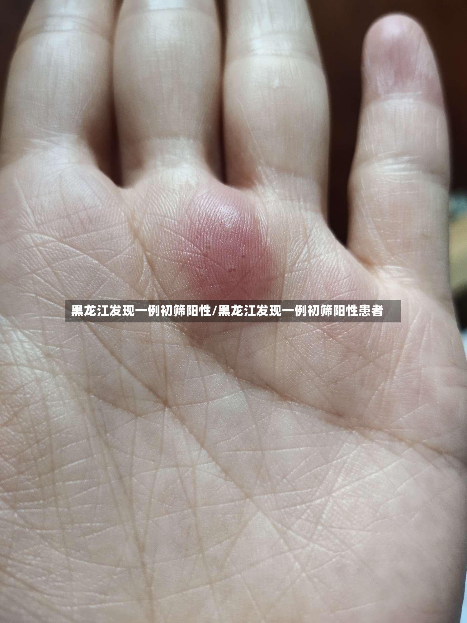 黑龙江发现一例初筛阳性/黑龙江发现一例初筛阳性患者-第2张图片